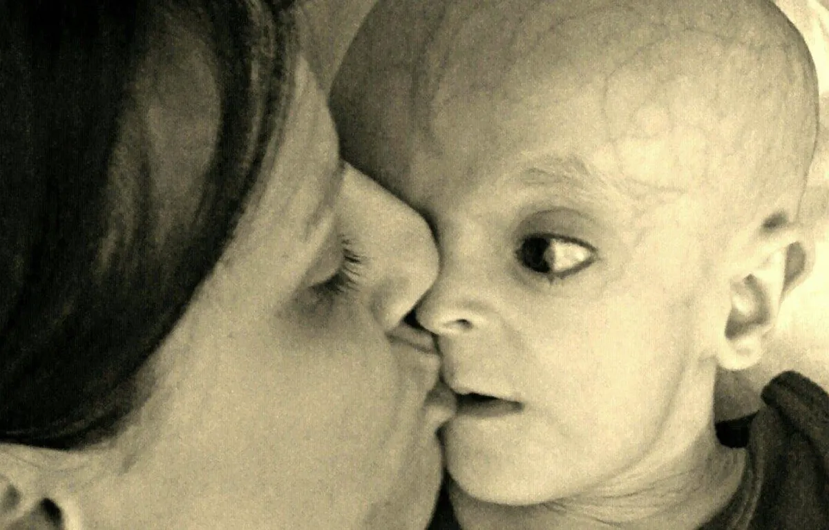 Storia di Simone, affetto dalla sindrome Lenz-Majewski, mamma Lorena: "Mi ha insegnato a essere fragile"