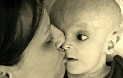 Storia di Simone, affetto dalla sindrome Lenz-Majewski, mamma Lorena: "Mi ha insegnato a essere fragile"