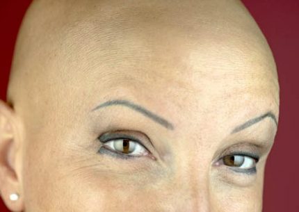 alopecia areata farmaco