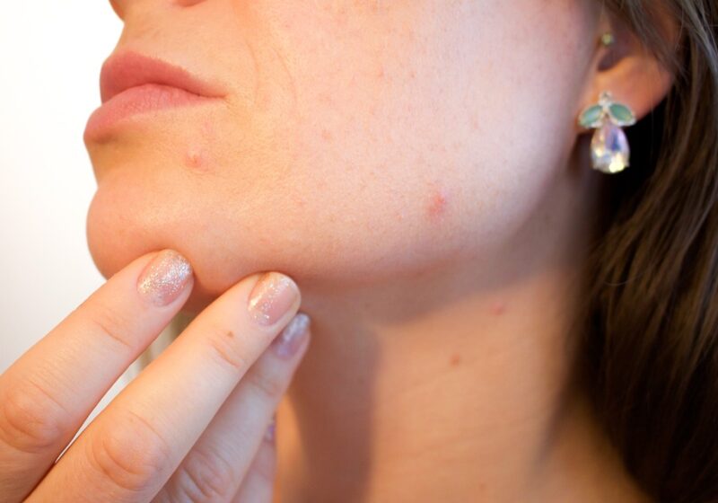 Cosa mangiare per combattere l'acne